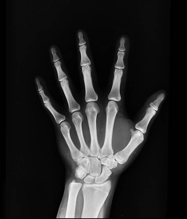 x-ray